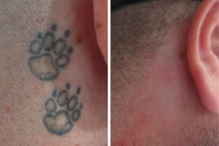 Lézeres tetoválás eltávolítás