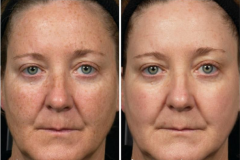 Pigmentfolt kezelés (E-Light IPL+RF)