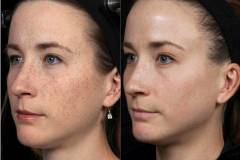 Pigmentfolt kezelés (E-Light IPL+RF)