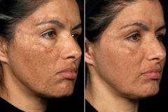 Pigmentfolt kezelés (E-Light IPL+RF)