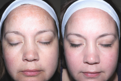 Pigmentfolt kezelés (E-Light IPL+RF)